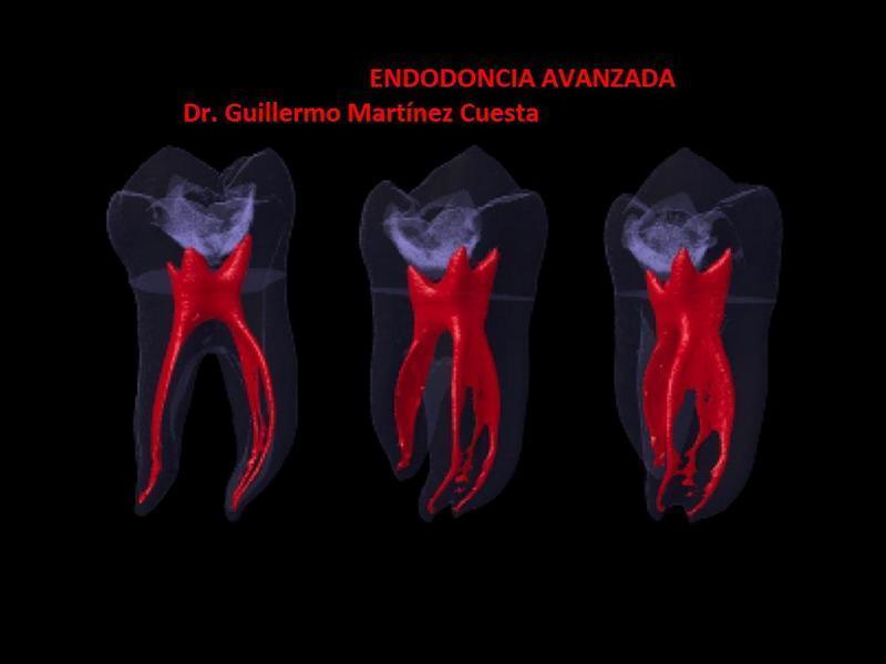 ¿Qué es una endodoncia?