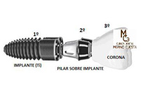Etapas de un tratamiento implantológico