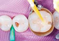 ¿Y después de la endodoncia?
