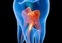 ¿Qué es una endodoncia?
